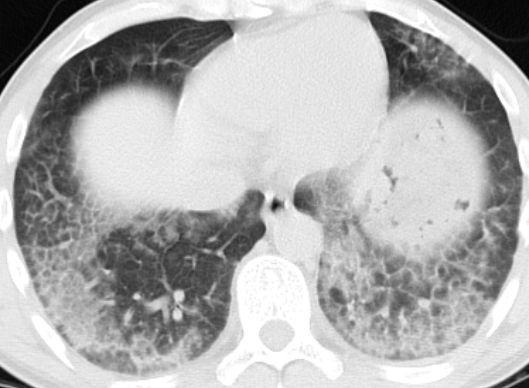 專家：肺部磨玻璃結(jié)節(jié)不一定等于肺癌