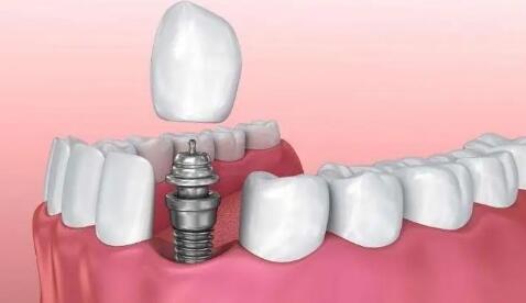 多地種植牙價格調(diào)控政策將于4月份實(shí)施 業(yè)內(nèi)人士稱市場需求將進(jìn)一步釋放
