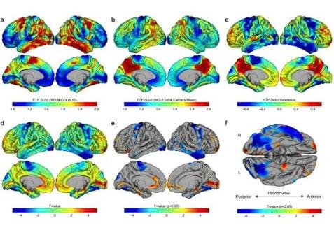 罕見(jiàn)！抗阿爾茨海默病“第二人”出現(xiàn)