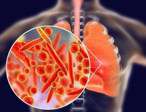 支原體肺炎導(dǎo)致的重癥、危重癥比例很低