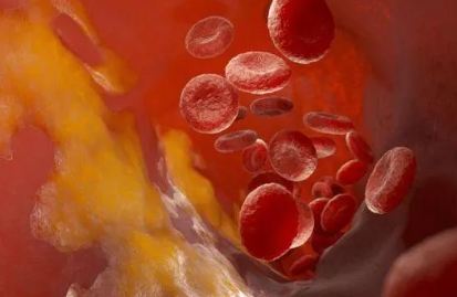 我國心腦血管疾病風(fēng)險(xiǎn)監(jiān)測將覆蓋35歲以上人群