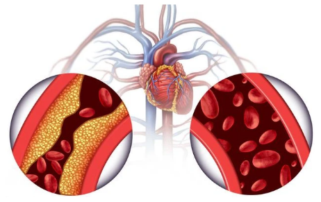 首次發(fā)病有年輕化趨勢(shì) 我國(guó)將建立心腦血管疾病綜合防控體系