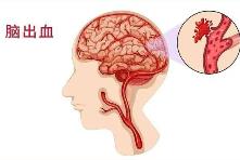 腦出血2小時內(nèi)強(qiáng)化降壓 可減少致殘致死風(fēng)險