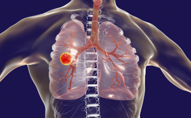 國(guó)家疾控局：全國(guó)結(jié)核病成功治療率保持在90%以上