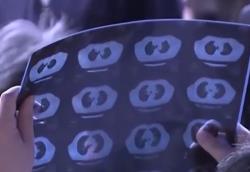 肺結(jié)節(jié)≠肺癌 專家建議這些人群應(yīng)做胸部CT